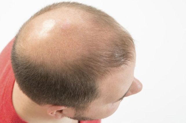 No hay cura para la calvicie