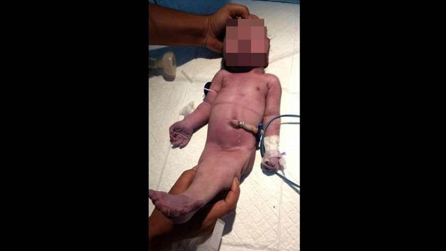 Bebé sirena sorprendió a la comunidad médica