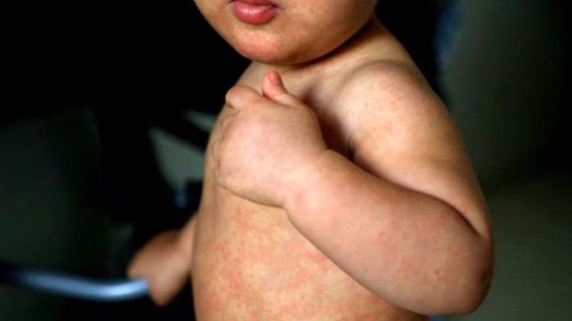 Alerta sanitaria por casos de sarampión