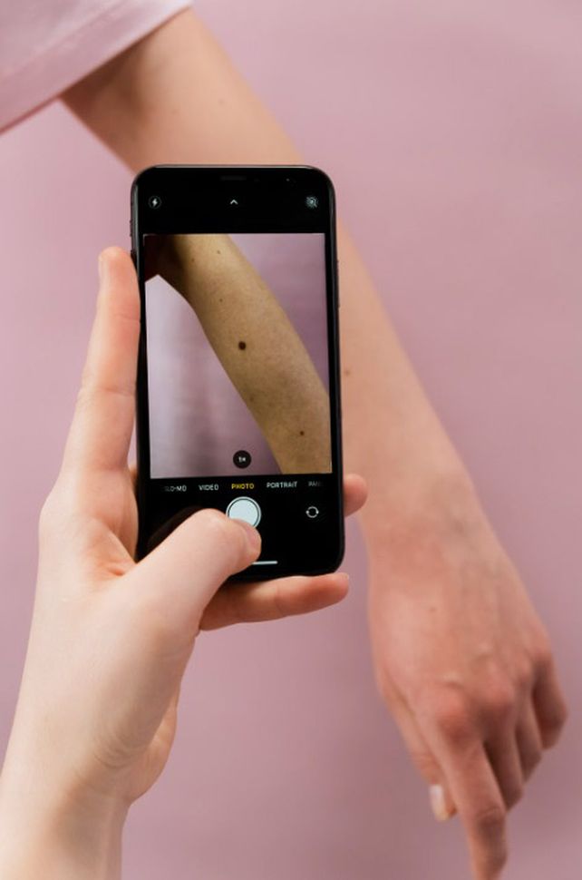Melanoma: advierten sobre el aumento de casos