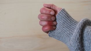 Un problema que afecta distintas zonas del cuerpo. ¿Cómo se trata?&nbsp;