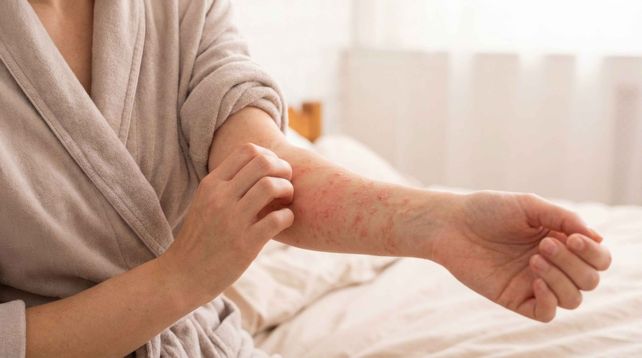 Dermatitis atópica: qué la causa, cómo reconocerla y cómo tratarla