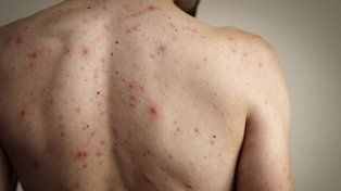 España dejó de estar libre de sarampión, según indicó la OMS