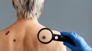 El melanoma es uno de los tipos de cáncer de piel más peligrosos y los especialistas destacaron la importancia de la detección temprana