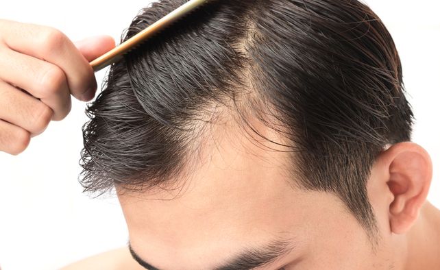 Caída del pelo