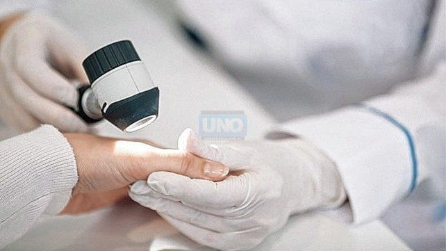 Control. Es importante evaluar lunares para realizar una detección precoz de cáncer de piel.