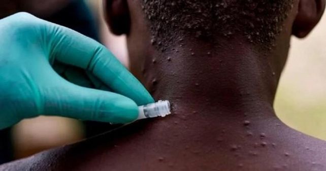 España, Portugal y el Reino Unido confirmaron casos de viruela del mono