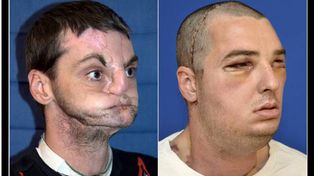 Realizan el transplante de rostro m&aacute;s completo de la historia en Estados Unidos