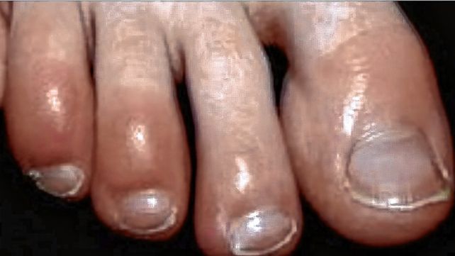 Ómicron produce otro síntoma: sabañones en manos y pies