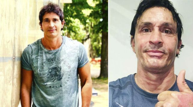 Sebastián Estevanez mostró cómo quedó su rostro tras quemarse con alcohol en gel