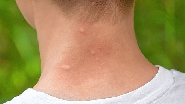 Jejenes se multiplicaron con el calor.