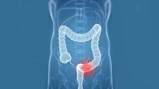 Distribuirán test para la detección temprana de cáncer de colon y recto