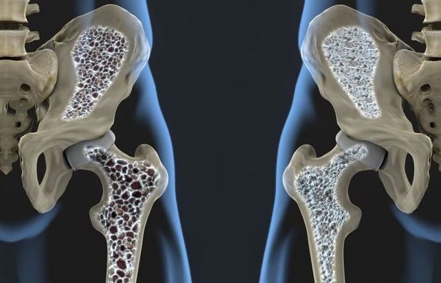 La osteoporosis también es una cuestión de hombres