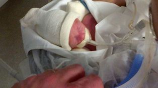 El bebé de 690 gramos que ayudó a su hermano mellizo mientras los dos luchaban por vivir