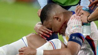 Mbappé se fracturó la nariz pero no será intervenido quirúrgicamente