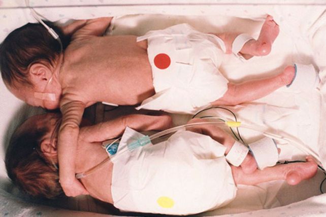 El abrazo de una gemela prematura a su hermana que le salvo la vida