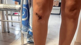 Los golpes que sufrió la adolescente en lo que fue el intento de secuestro en Aristóbulo del Valle y Azcuénaga.&nbsp;