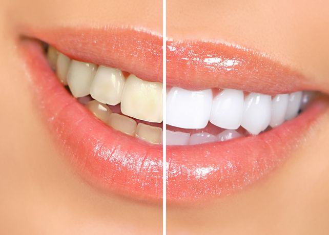 Por qué se ponen amarillos los dientes y qué se puede hacer para evitarlo