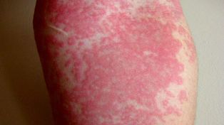 Preocupan casos de urticaria crónica de origen desconocido