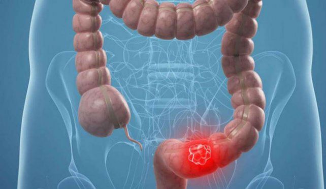 Detectan altísima tasa de cáncer de colon por falta de un control temprano