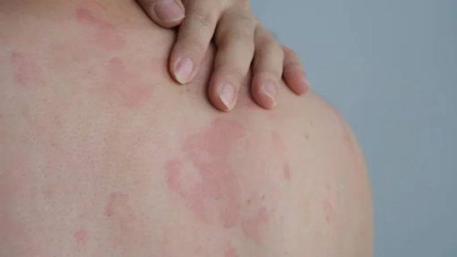 Lanzan campaña nacional gratuita para detectar la psoriasis