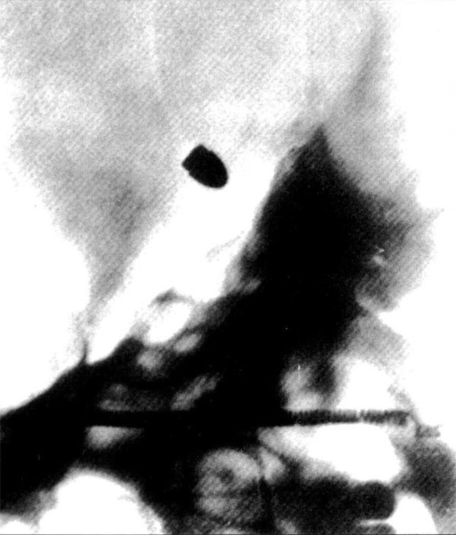 Radiografía de abril de 1896.