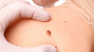 Ya está disponible la vacuna argentina contra el cáncer de piel