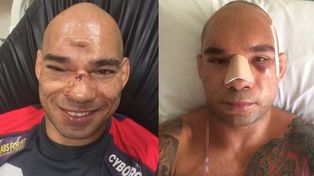 Así le quedó el cráneo al luchador que había sufrido una fractura en un combate