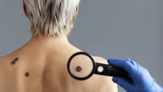 Villa Elisa: campaña de prevención del cáncer de piel