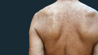 Las manchas blancas que salen en la piel ¿son solo un tema estético?&nbsp;
