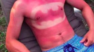 Una moda juvenil de tatuarse con el sol preocupa a los especialistas de la piel