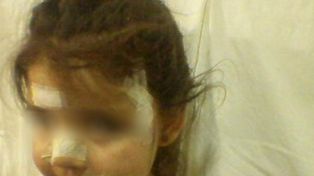Un perro callejero desfiguró a una nena de tres años en San Lorenzo