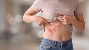 Culebrilla: por qué el virus de la varicela puede despertar décadas después