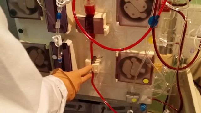 Tenía tanta grasa en la sangre que tapaba los equipos: lo salvaron con una sangría