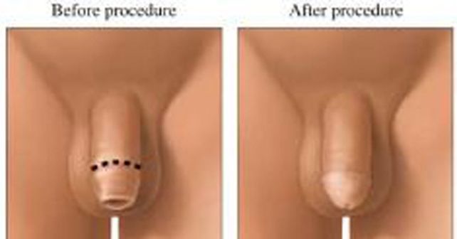 La circuncisi&oacute;n reduce el contagio de enfermedades como el sida
