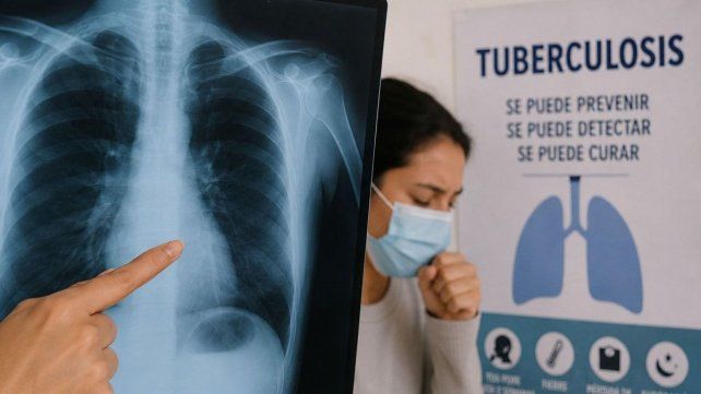 Aumentaron los casos de tuberculosis en Santa Fe&nbsp;