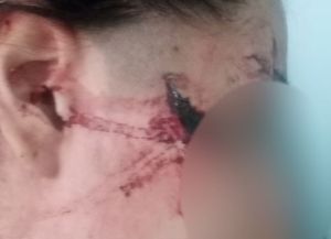Brutal agresión a una adolescente en San Cristóbal: la víctima se recupera y será evaluada por un cirujano estético