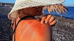 Cómo cuidar la piel con la exposición al sol en verano