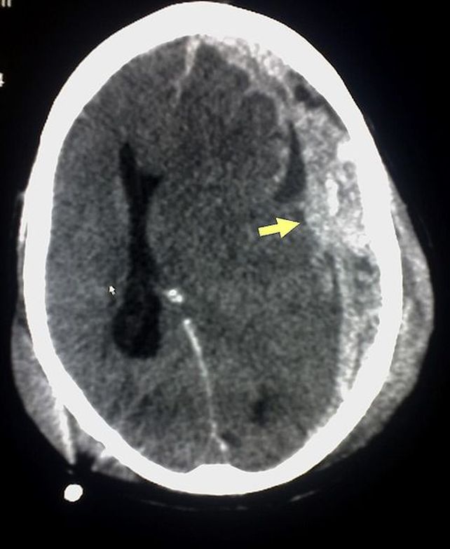 La imagen de esta tomografía computarizada es un ejemplo de hemorragia subdural secundaria a trauma.