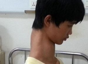 El chico jirafa sorprende a China que busca soluciones para acortar su cuello