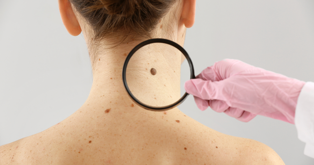 El melanoma tiene una alta letalidad. Un equipo argentino desarroll&oacute; una vacuna eficaz contra este tipo de c&aacute;ncer de piel.