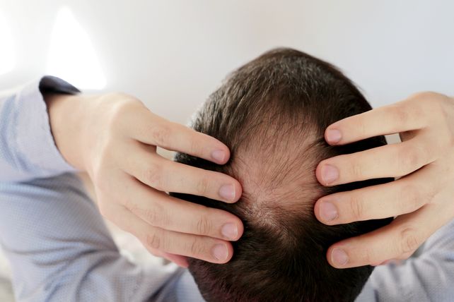 Qué tratamientos elegir para evitar llegar a la calvicie