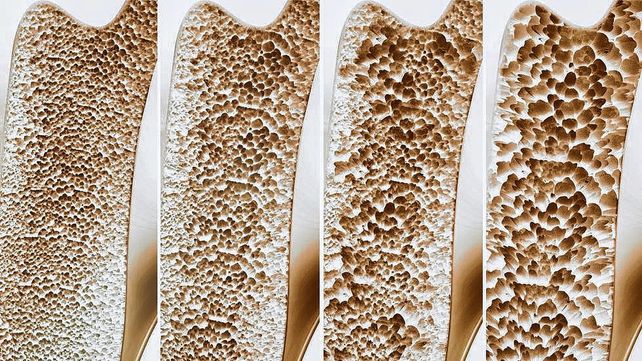 Las fracturas óseas se incrementan con la osteoporosis