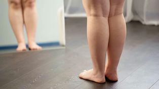 El lipedema causa inflamación, dolor y pesadez en las piernas