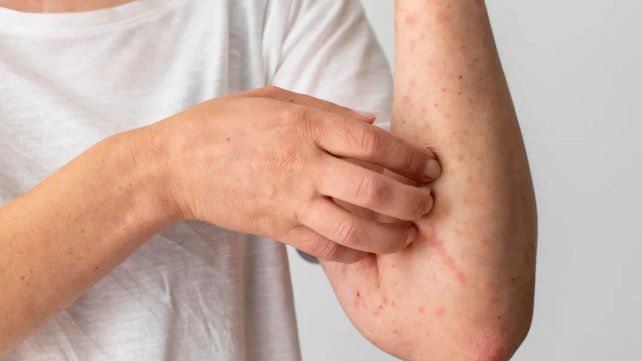 Un nuevo caso confirmado de Sarampión en Argentina