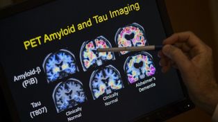 La agencia de medicamentos de EEUU aprobó una droga para tratar el alzheimer