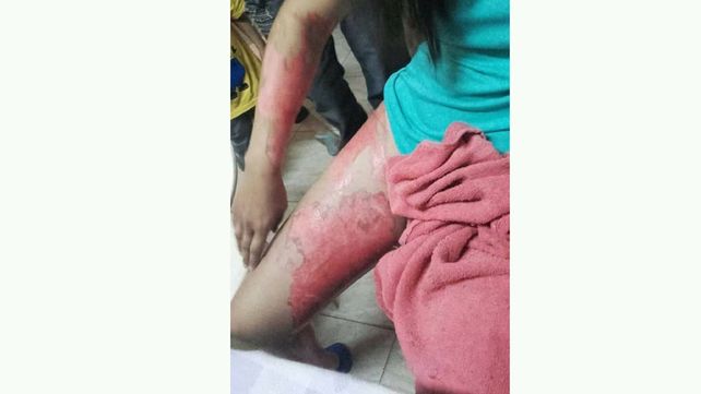 Un boxeador roció con nafta y prendió fuego a su novia