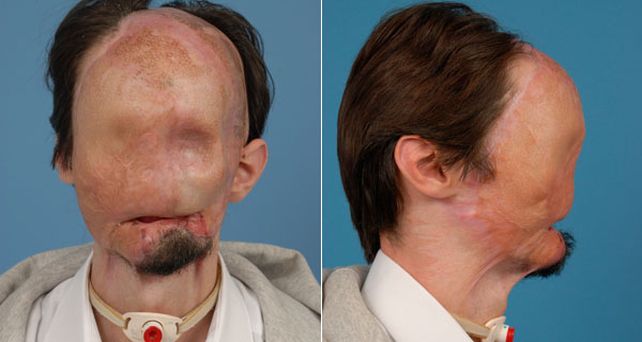 Tras un nuevo transplante, el hombre sin rostro tiene una cara nueva