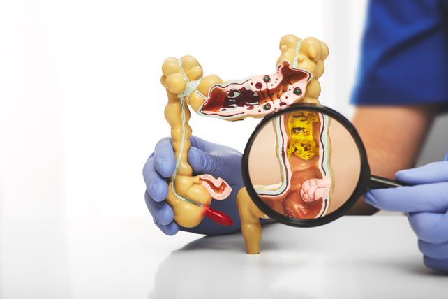 Cáncer colorrectal: la ventana de diez años que permite neutralizarlo antes de que aparezca