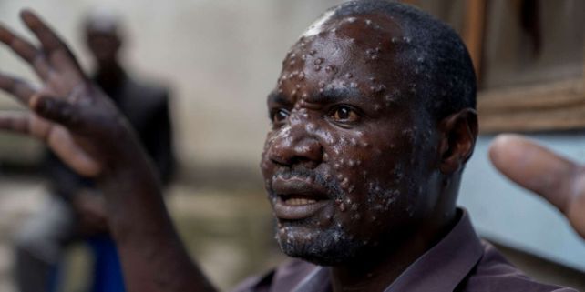 El brote y el 96% de los casos y muertes de este tipo de viruela se han producido en el Congo.